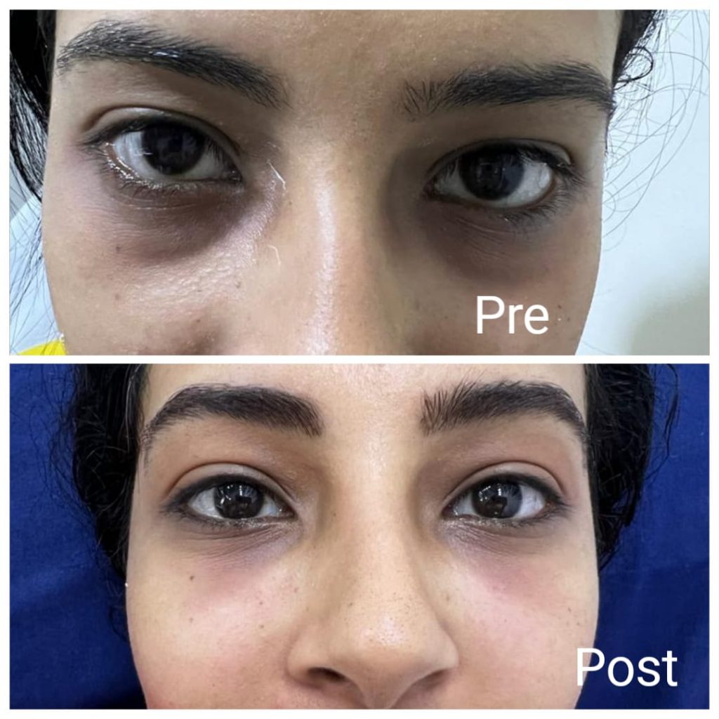 أفضل أطباء حقن الفيلر لعلاج الهالات السوداء